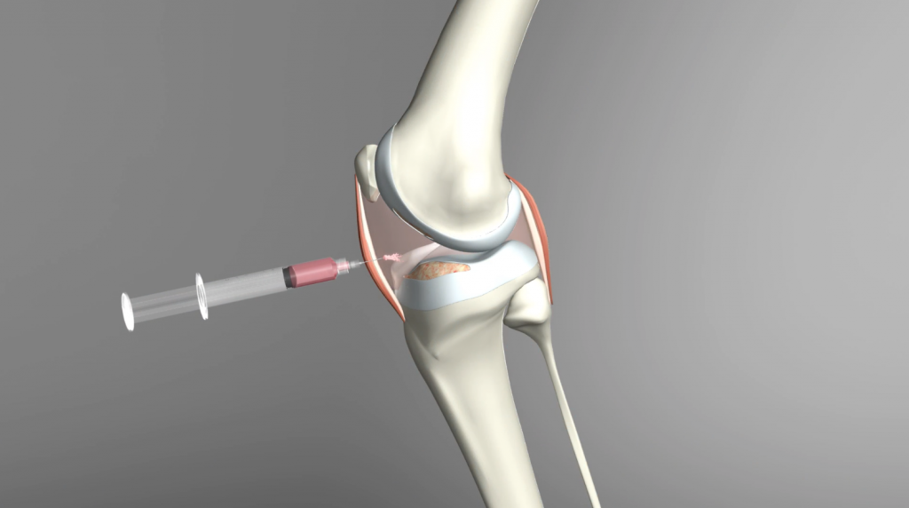 PRP Injection