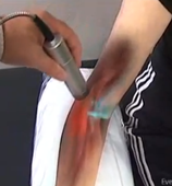 laser therapy overview