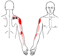 Trigger Points