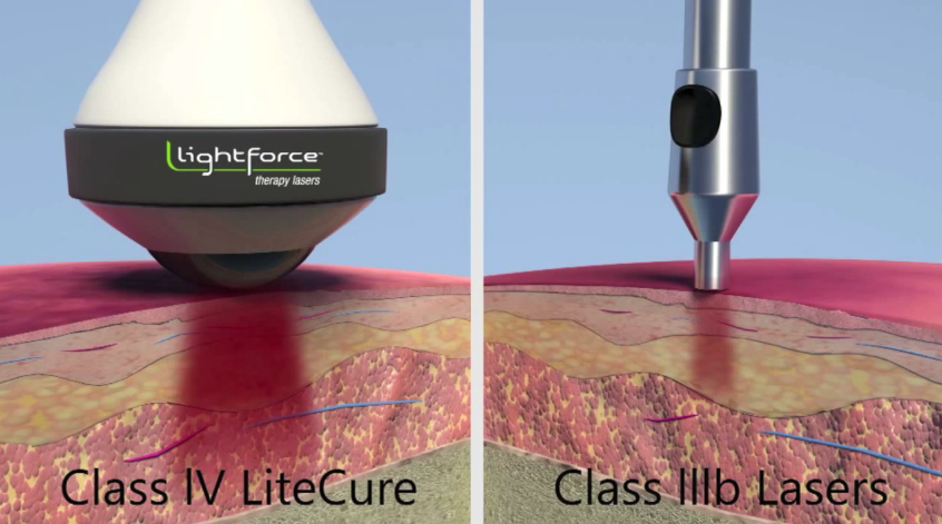 Class III vs Class IV_LightForce