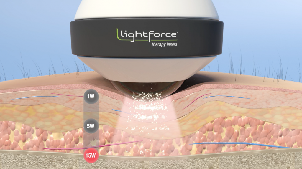 PBM Dosing Video_LightForce_Screenshot 8