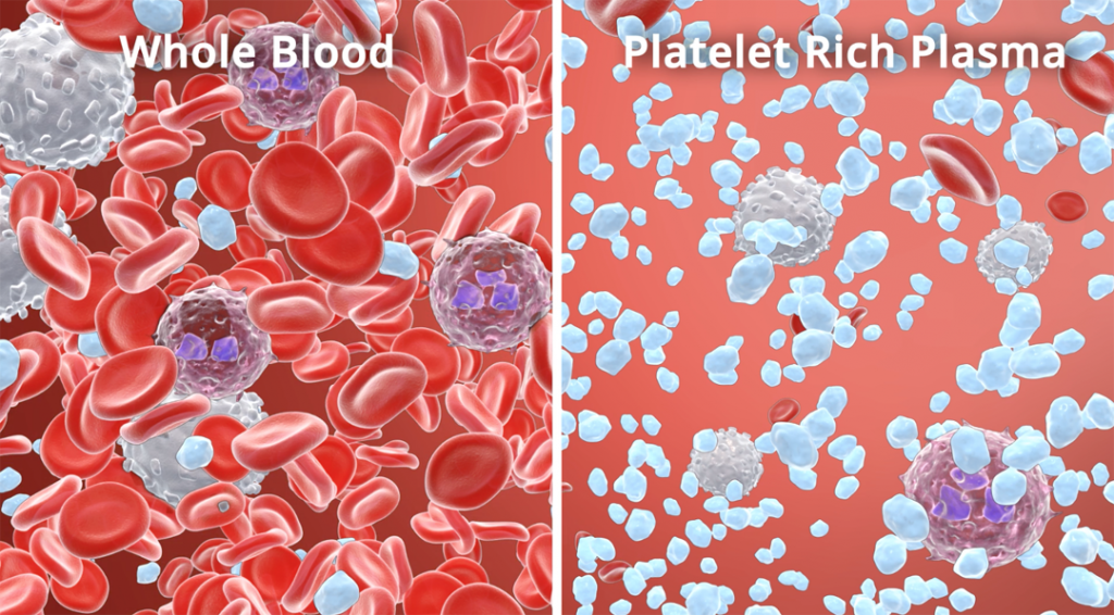 Whole Blood Vs PRP_Small